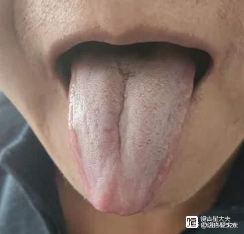 舌尖塌陷中医_舌尖凹陷的医治_