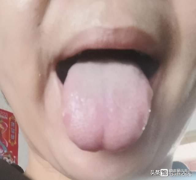 _舌尖塌陷中医_舌尖凹陷的医治