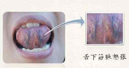[转载]舌下静脉和肛门静脉的对应关系