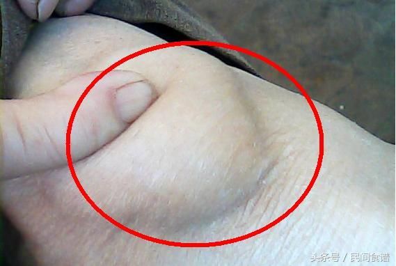 8年滑膜炎，花了十几万！没想到一把野草治好了，64岁大爷健步如飞