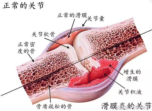 8年滑膜炎，花了十几万！没想到一把野草治好了，64岁大爷健步如飞