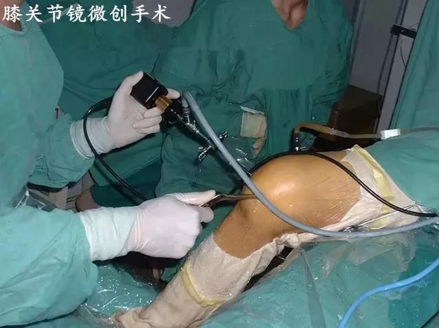 8年滑膜炎，花了十几万！没想到一把野草治好了，64岁大爷健步如飞