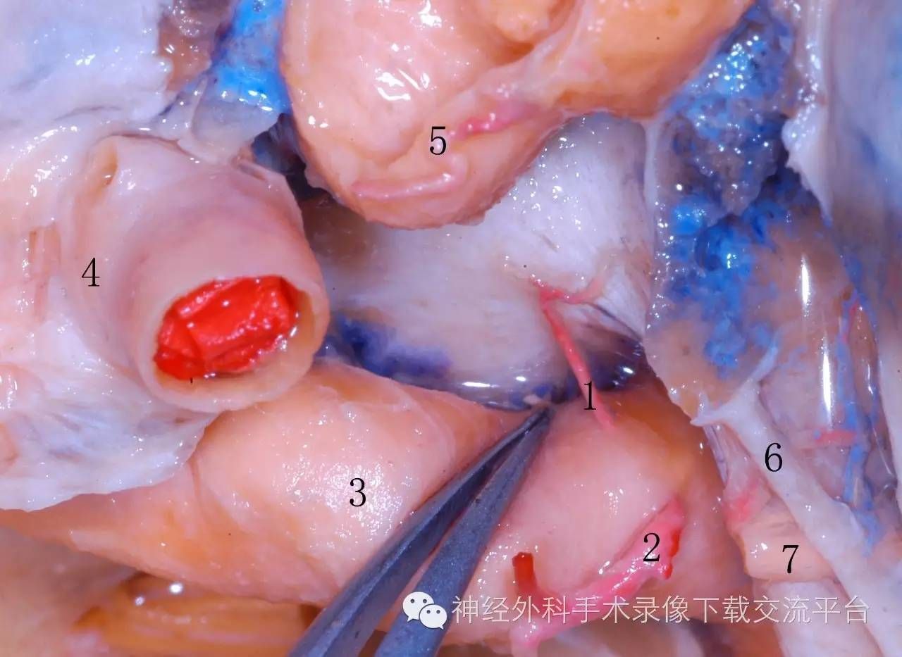 海绵窦段解剖_海绵窦解剖_
