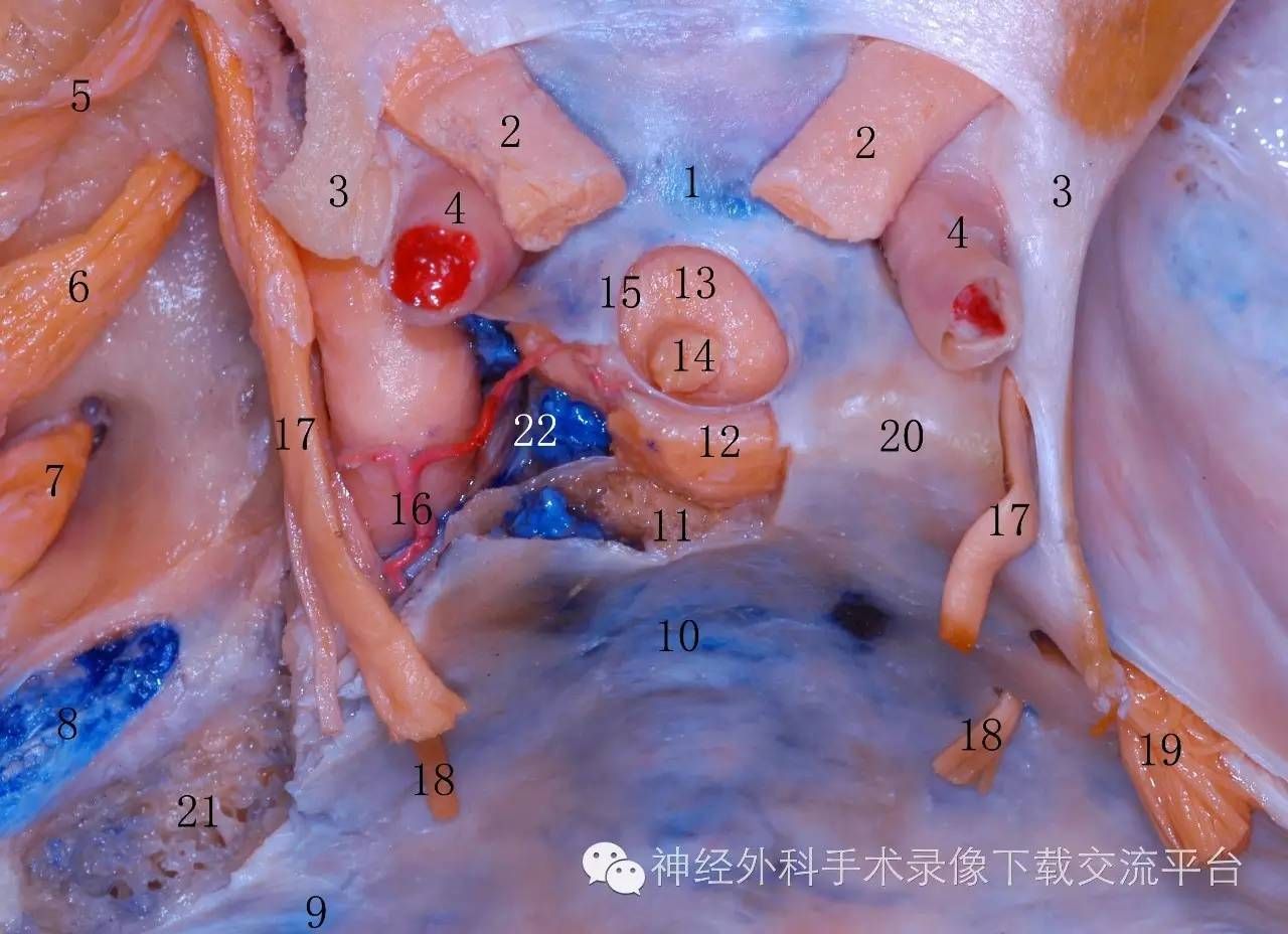 海绵窦解剖__海绵窦段解剖