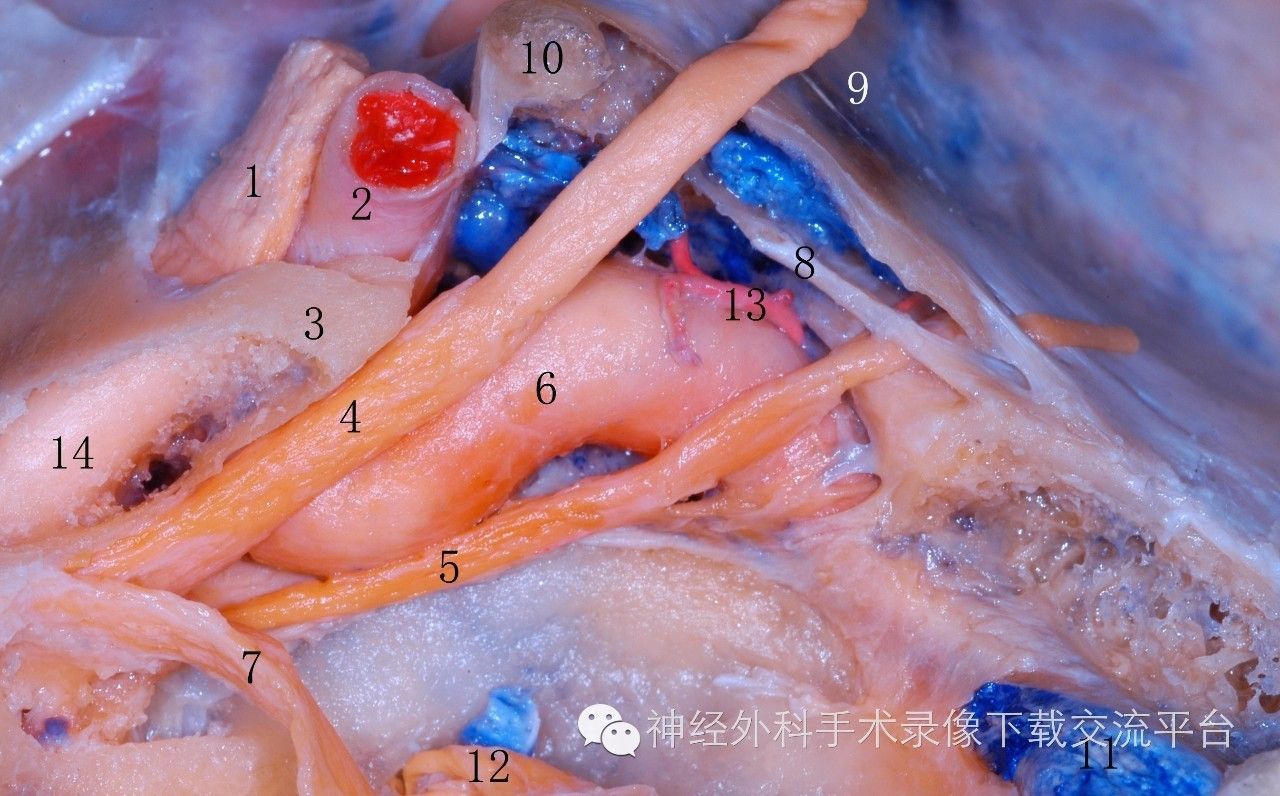 海绵窦解剖__海绵窦段解剖