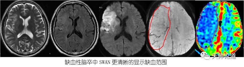 磁敏感加权成像从技术到临床之——在缺血性脑卒中的临床应用_磁敏感加权成像从技术到临床之——在缺血性脑卒中的临床应用_