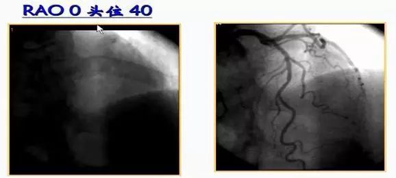 _造影程序_造影流程以及注意事项