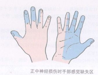 正中神经检查实验_正中神经ppt_