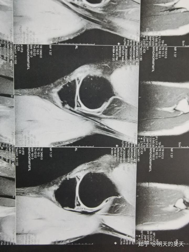 半月板3级撕裂--已关节镜手术