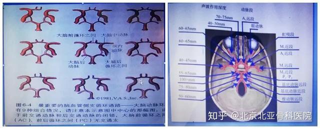 【北亚技术科普】颅内动脉的超声评价——经颅彩色多普勒（TCCS）的临床应用！