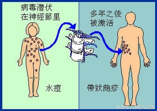 带状疱疹疼痛难忍，这三种偏方可治愈，没有后遗症