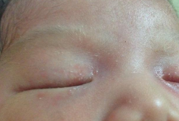 孩子眼睛经常红肿，是怎么回事？什么引起的？
