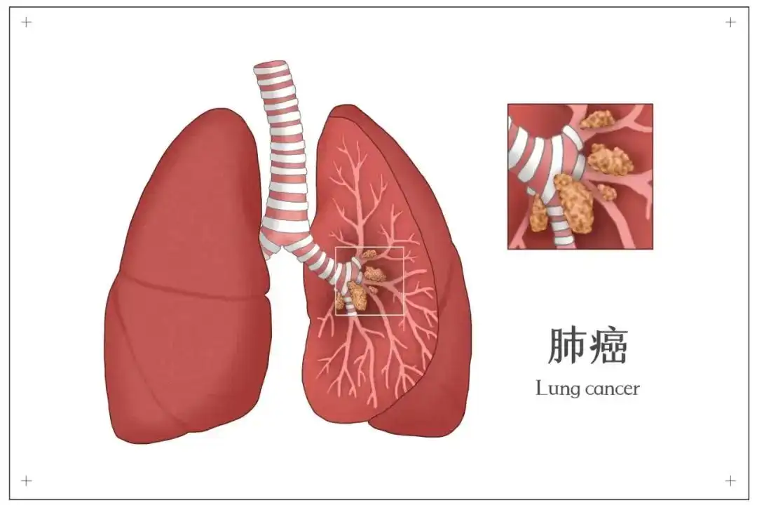 中医张胜兵医案—肺癌术后又复发，瘦得只有60多斤，中药治疗2月后...