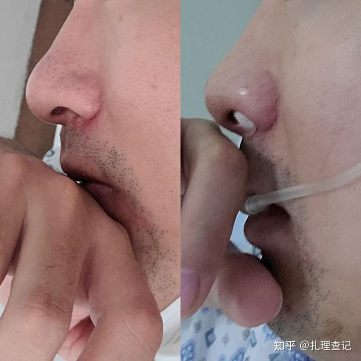 血痂_血痂快速去除的方法_血痂什么意思