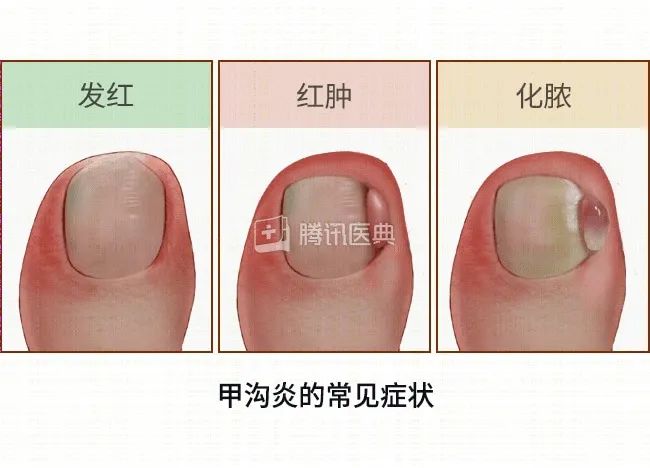 让指甲疼痛化脓的甲沟炎，怎么治？