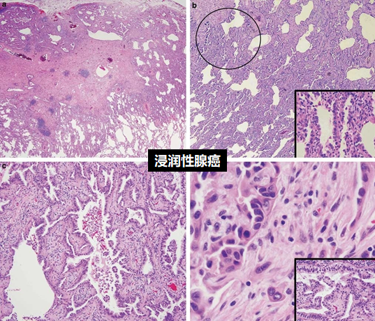 巧用麻黄“提壶揭盖”治闭经