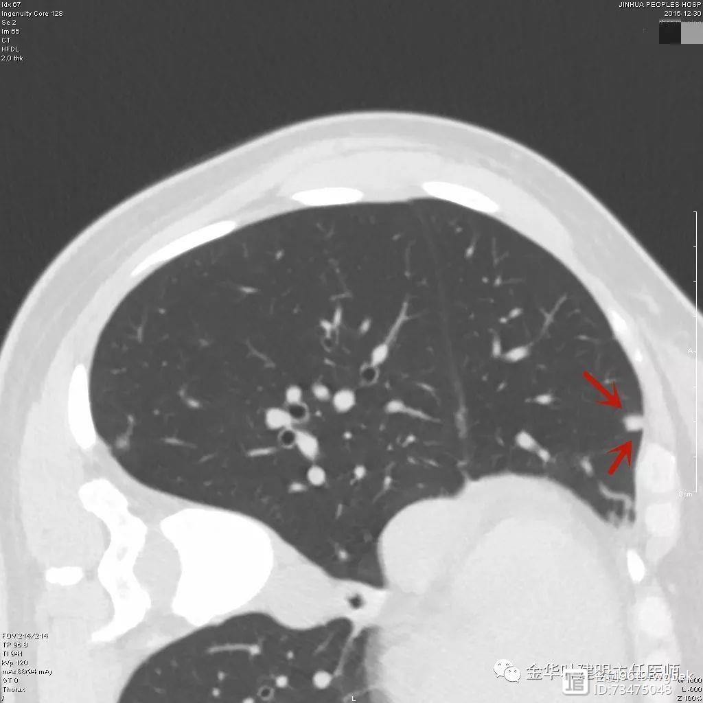 _影像学淋巴结标准_术中淋巴显影