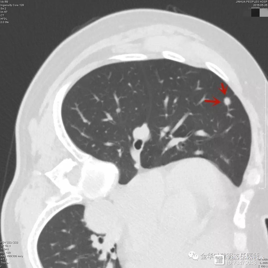 _术中淋巴显影_影像学淋巴结标准