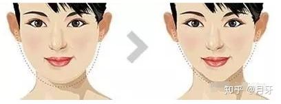 面部吸脂多久能消肿，多长时间才能达到最佳效果?术后护理需要注意哪些？