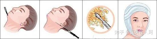 面部抽脂_面部抽脂的危害_面部抽脂多久彻底消肿
