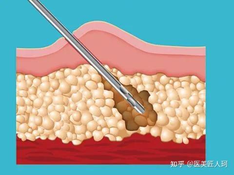 面部抽脂的危害_面部抽脂多久彻底消肿_面部抽脂